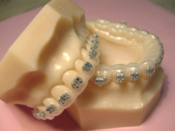 Ortodoncia, Aparatolog&iacute;a fija