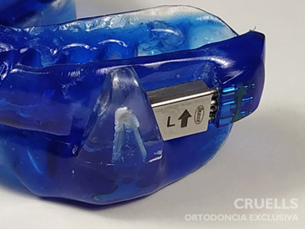 Ortodoncia, aparatos apnea