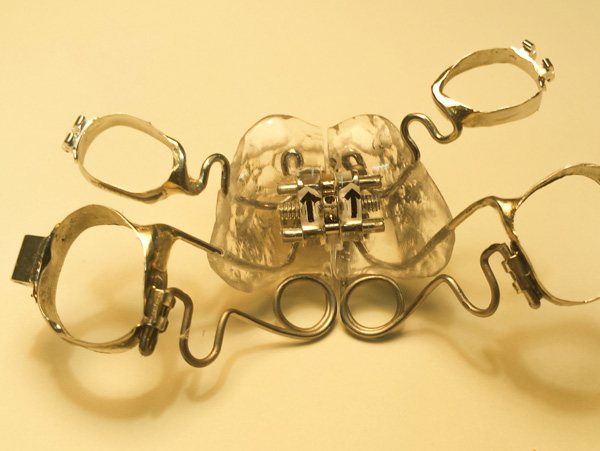 Ortodoncia, P&eacute;ndulo de Hilguers