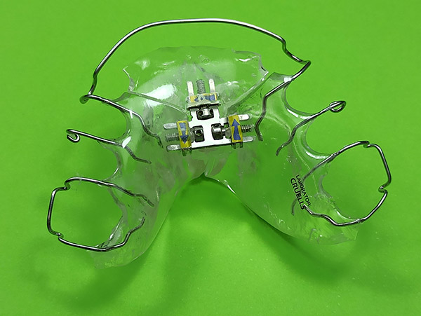 Ortodoncia, Plaxcas Activas