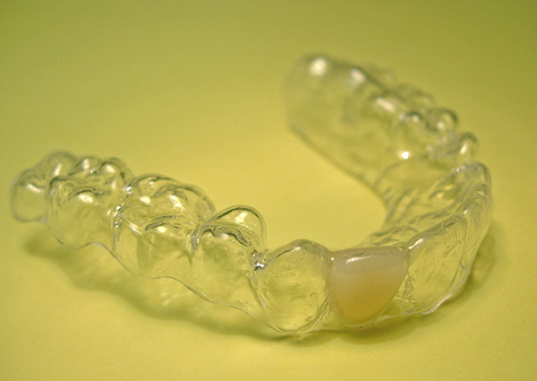 Ortodoncia, retenci&oacute;n