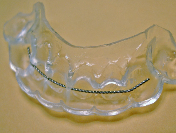 Ortodoncia, retenci&oacute;n